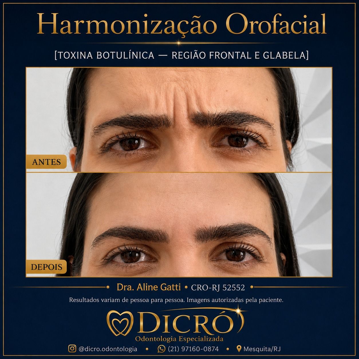 Botox Antes e Depois