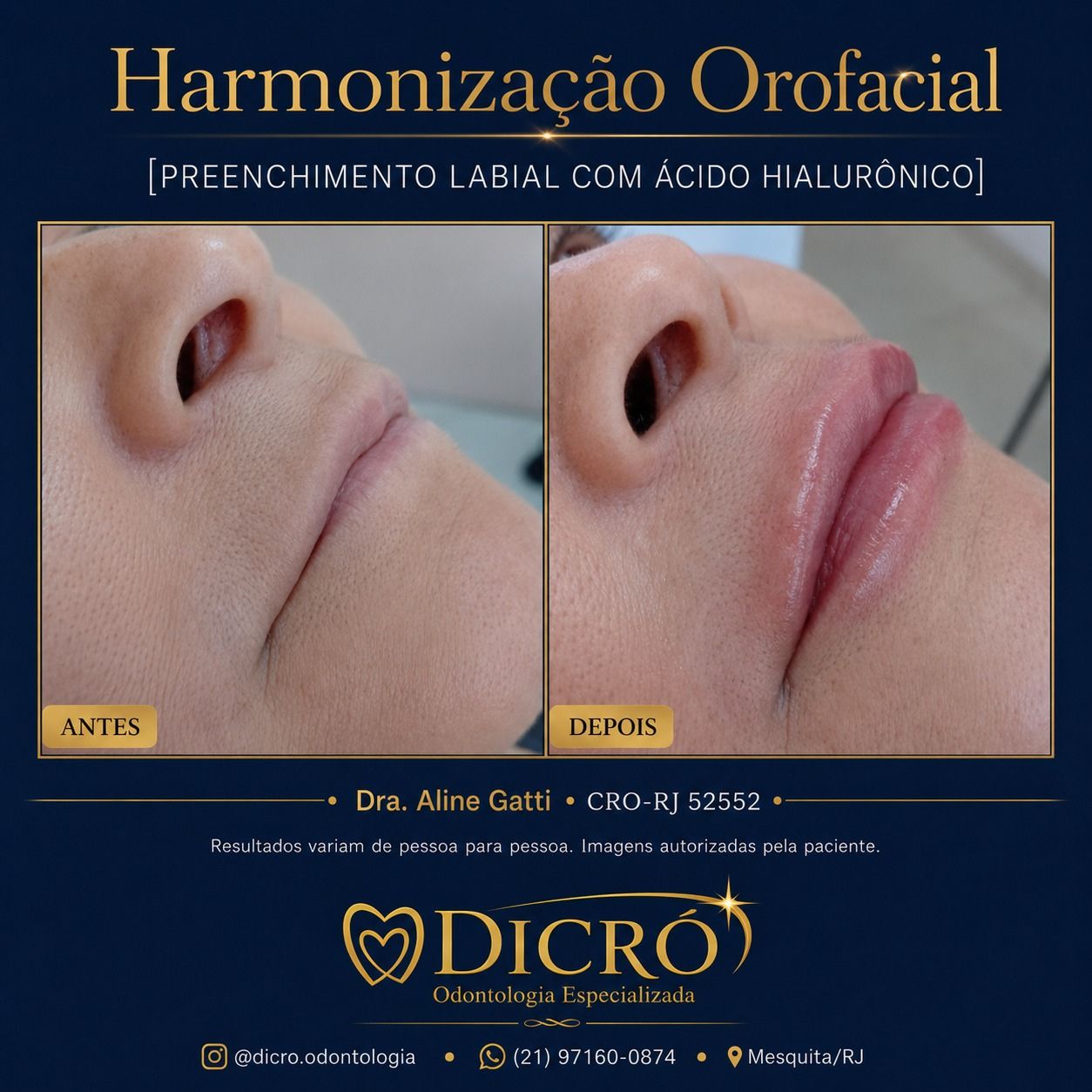 Preenchimento Labial Antes e Depois